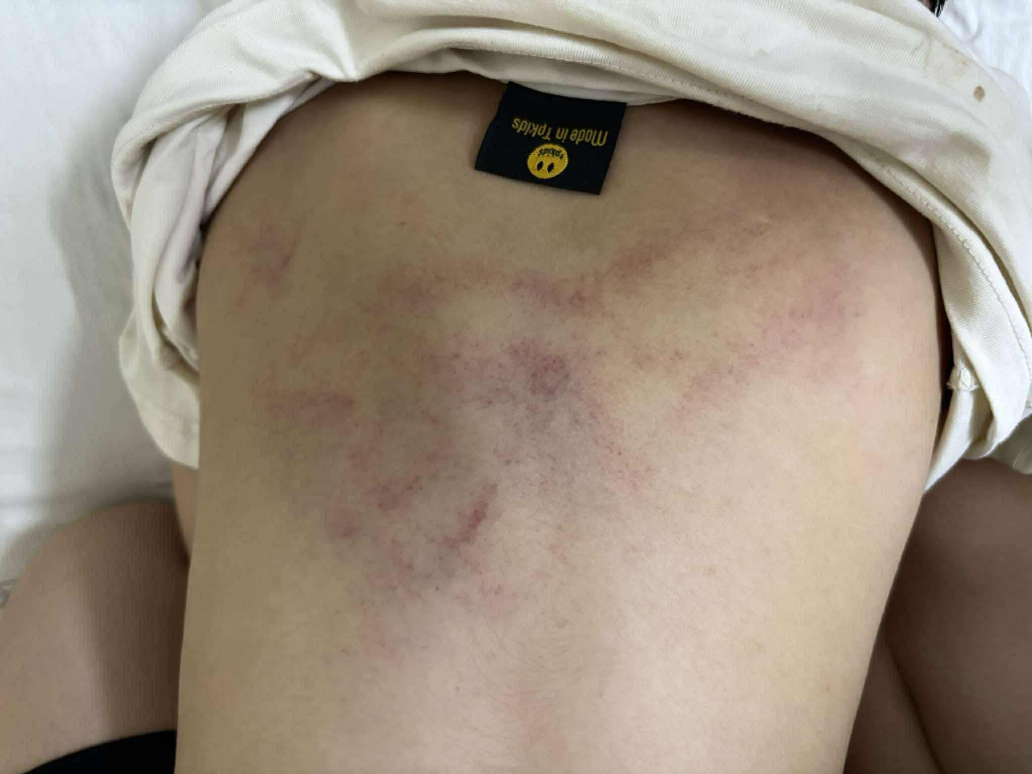 Bé 4 tuổi ở Hà Nội bị giáo viên đánh tím lưng vì 'không chịu đi ngủ'