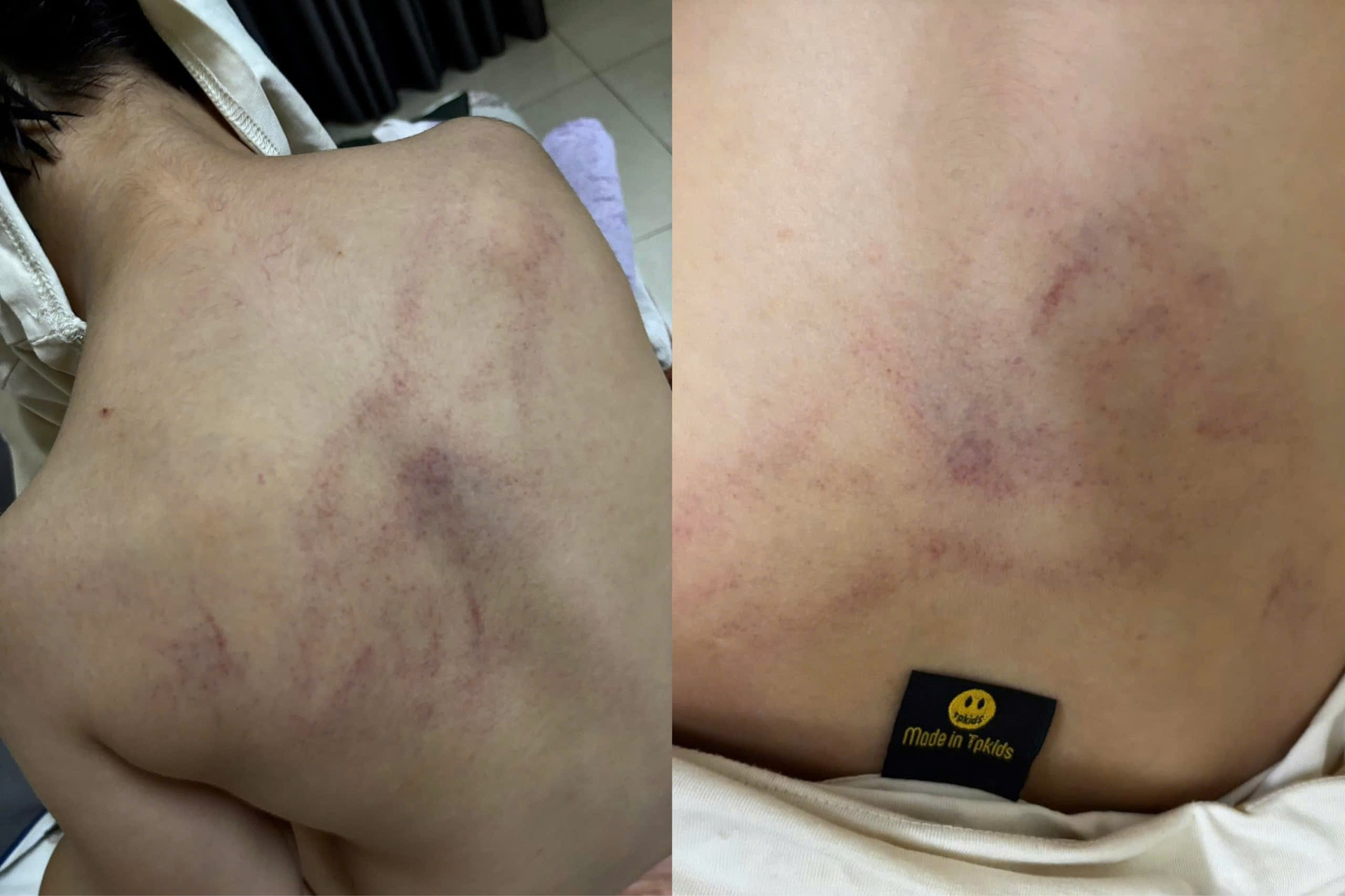 Vụ bé gái 4 tuổi bị đánh tím lưng: Đình chỉ thêm 1 giáo viên