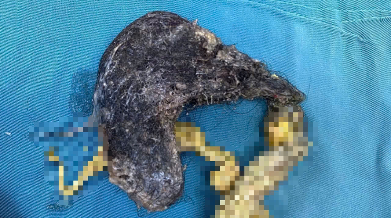  Lấy búi tóc nặng nửa ký khỏi dạ dày bệnh nhi 5 tuổi