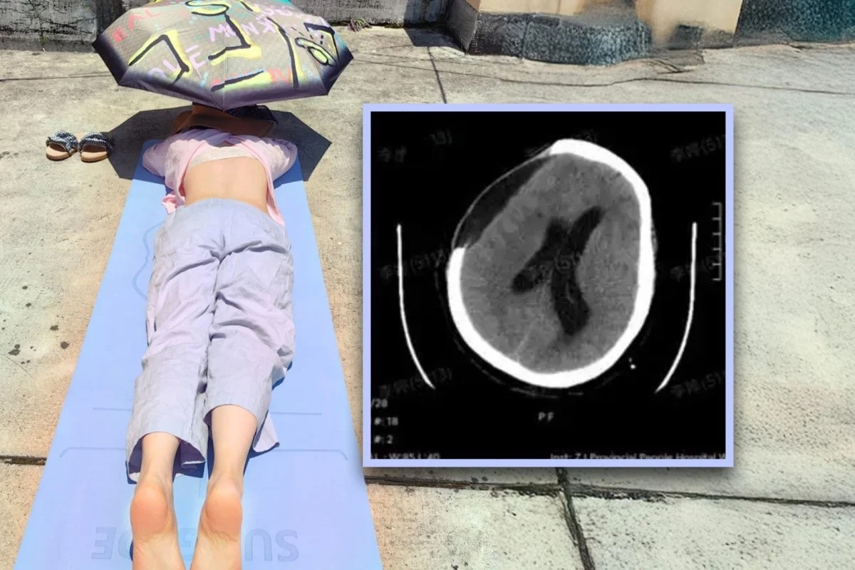 Tắm nắng cho khỏe, người phụ nữ bị xuất huyết não, hôn mê