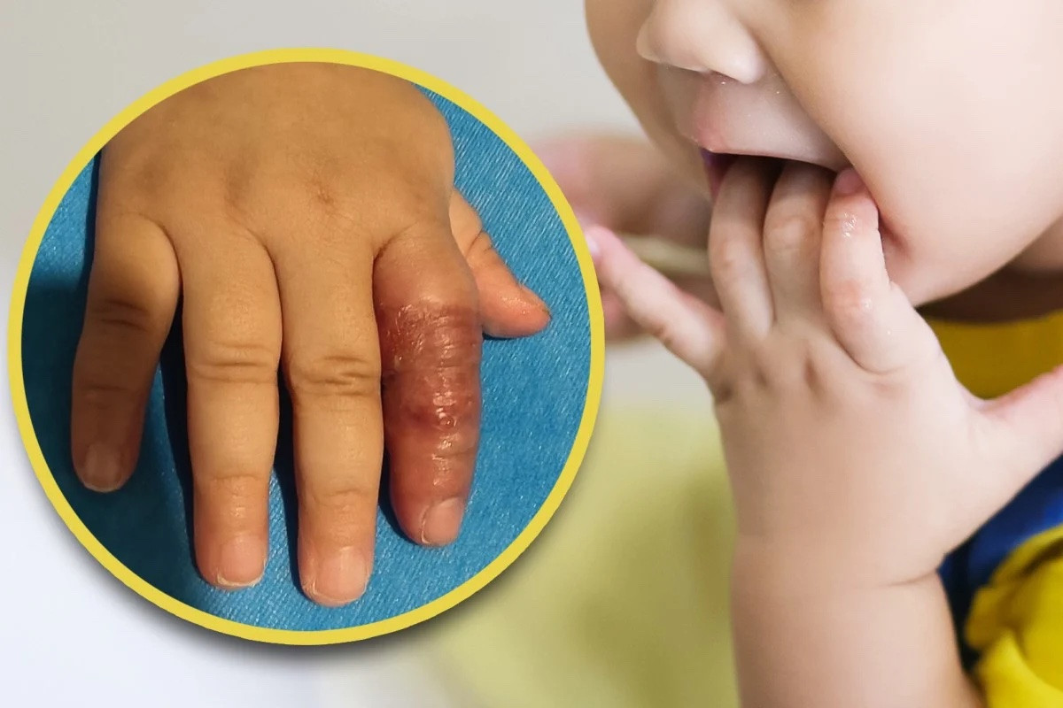 Mẹ dùng băng quấn để ngăn con mút tay, em bé suýt phải cắt cụt ngón 