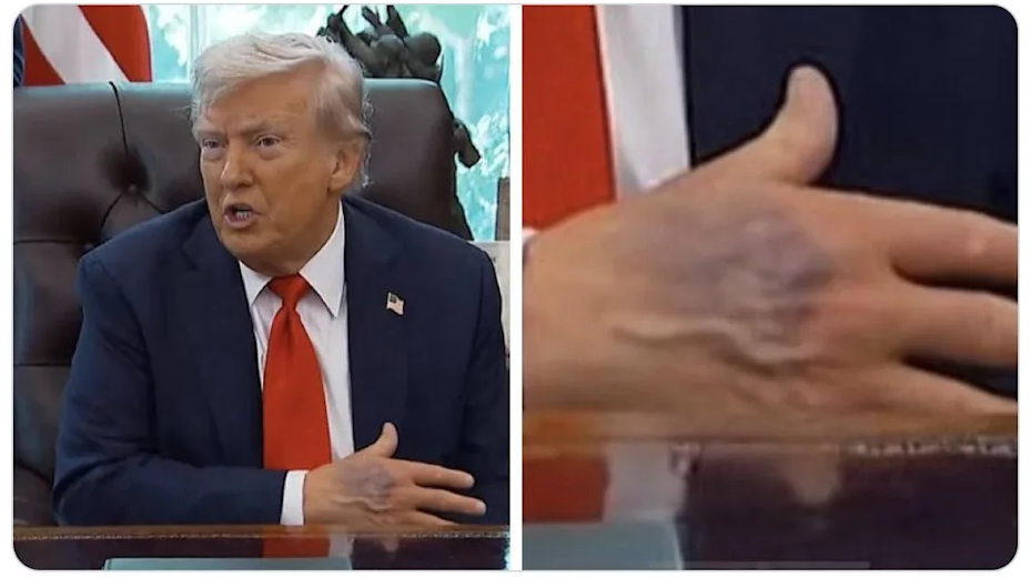 Bàn tay thâm tím của ông Trump gây chú ý 