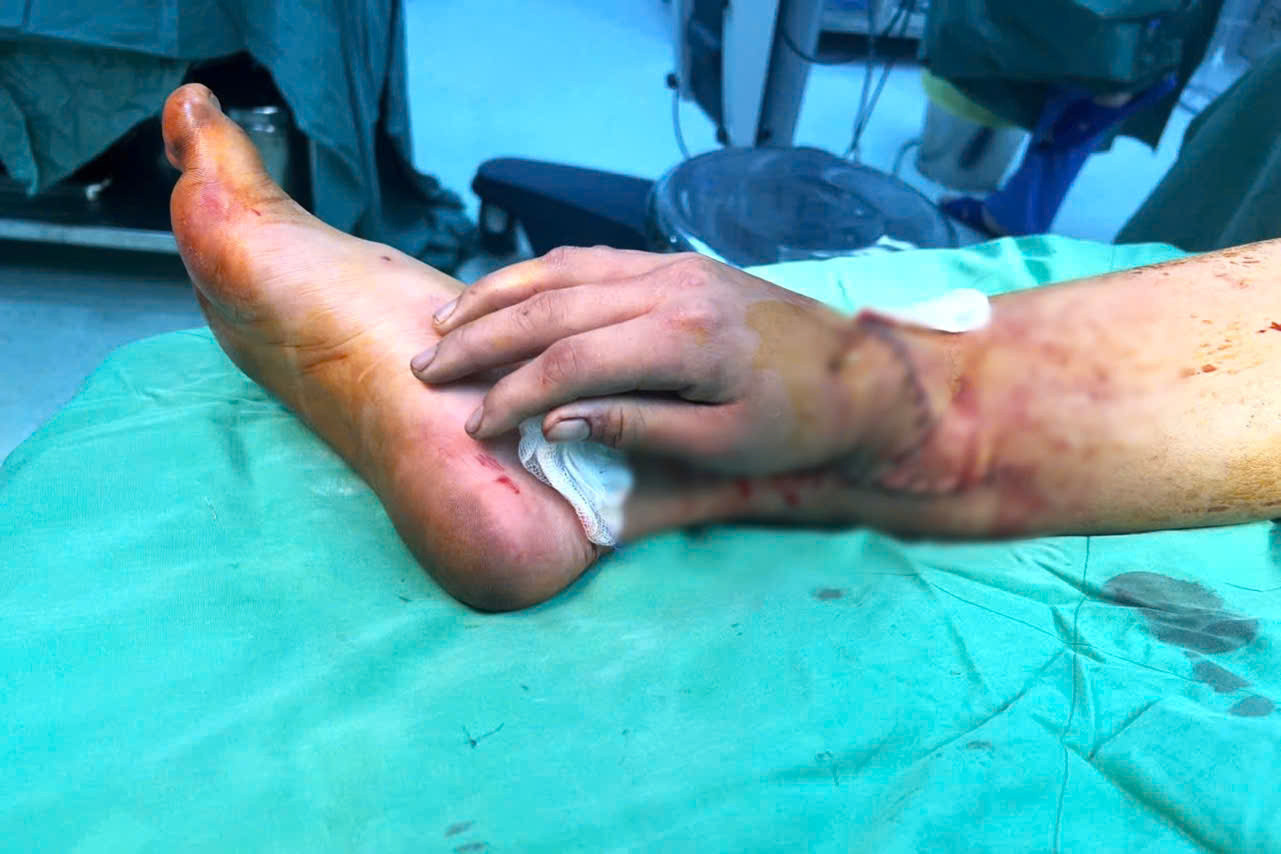 Kỳ tích ở TP.HCM: Bác sĩ ghép bàn tay đứt lìa vào cổ chân mẹ bầu song thai