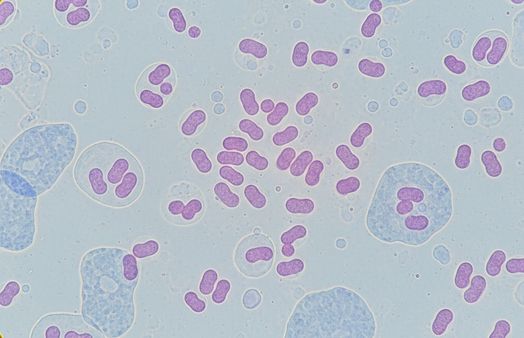 Hà Nội ghi nhận ca mắc não mô cầu là trẻ 11 tuổi, chưa tiêm vaccine