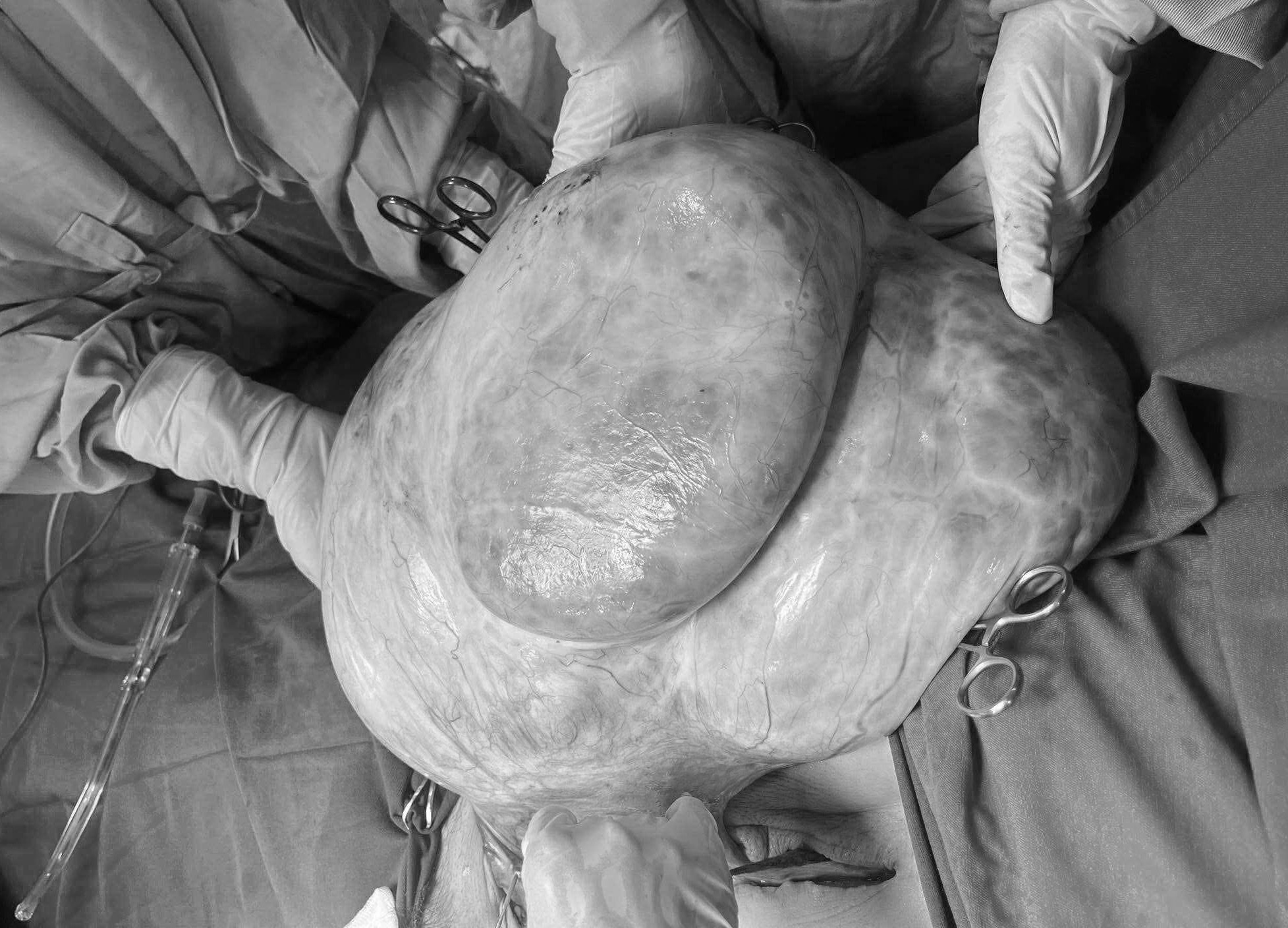 Bụng to tưởng béo, người phụ nữ không ngờ mang khối u buồng trứng 15kg