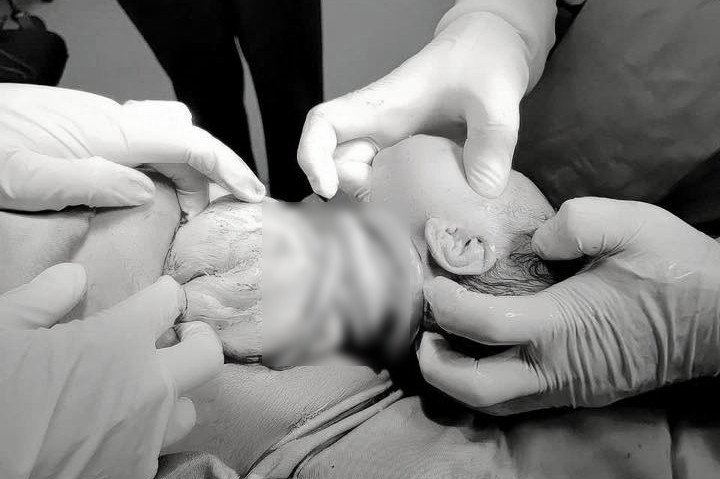 Bé gái chào đời với 6 vòng dây rốn quấn cổ, mẹ tiền sản giật