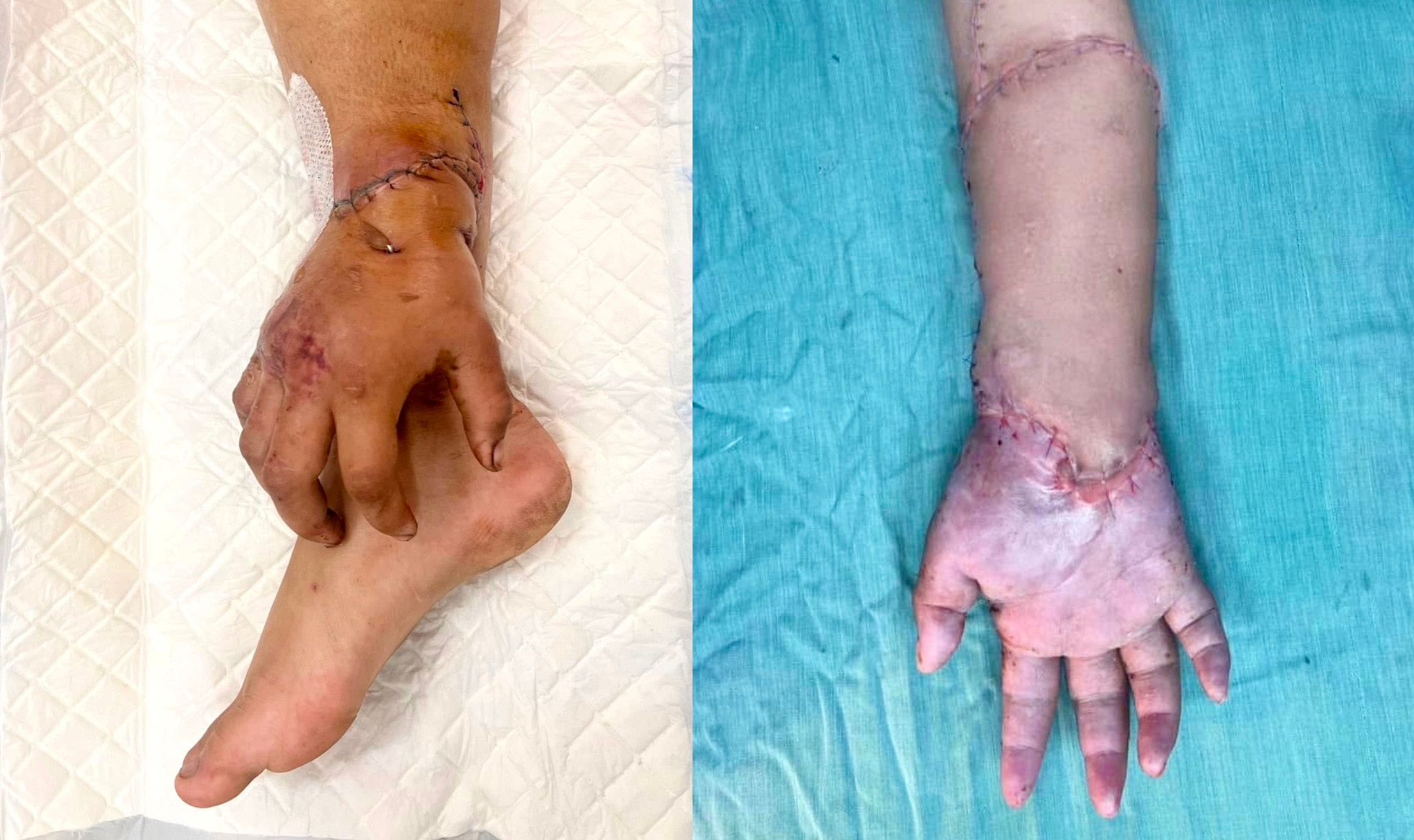 Bàn tay đứt lìa của mẹ bầu được nối lại sau thời gian 'nuôi' ở chân