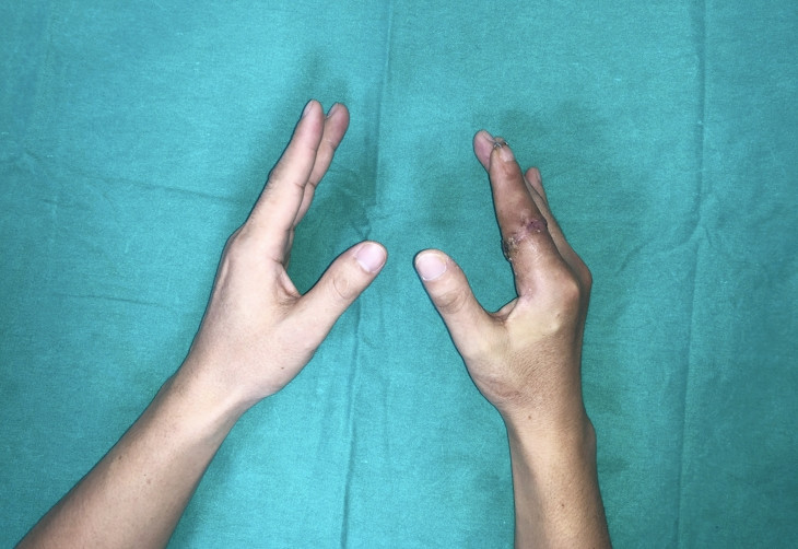 Ngón tay thủy thủ 'sống lại' sau 25 giờ đứt rời giữa tâm bão