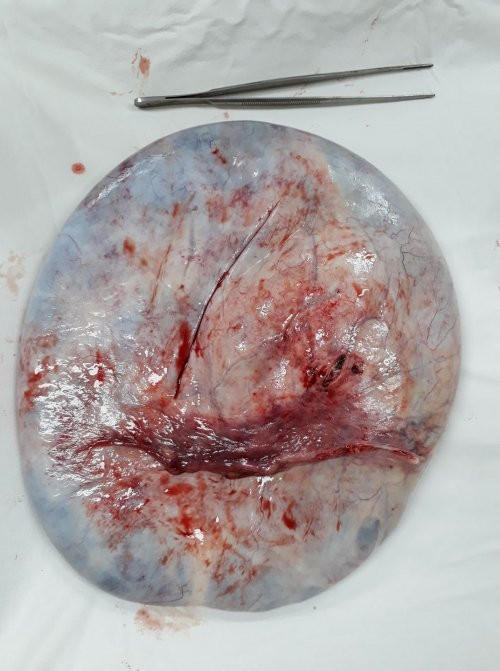 Hinh anh Mang khoi u nang buong trung 15kg, benh nhan bi nham co bau