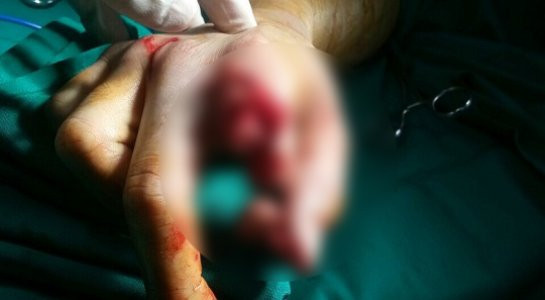 Hinh anh Noi lien ngon tay cho nam thanh nien bi may xay thit cat dut lia