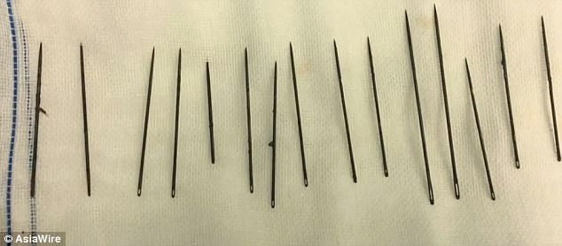 bac-si-toat-mo-hoi-khi-mo-gap-15-cay-kim-cho-quy-ong-thich-tu-suong-1