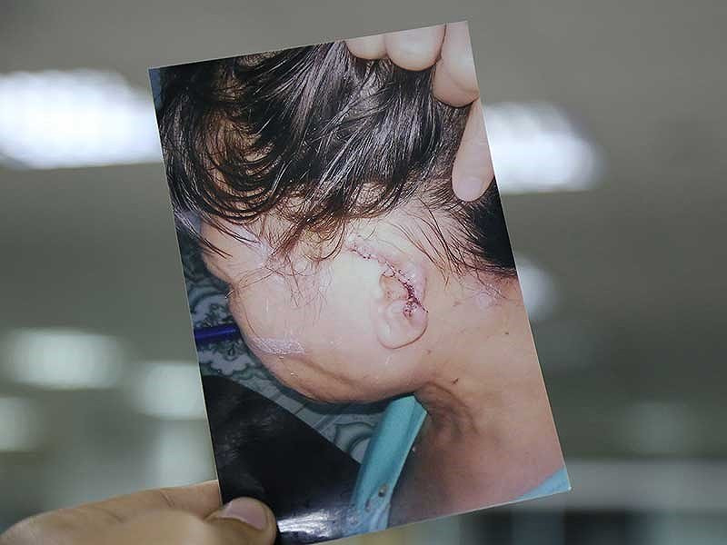 Cắn người đứt tai, thoát tội nhờ quy định mới - ảnh 1