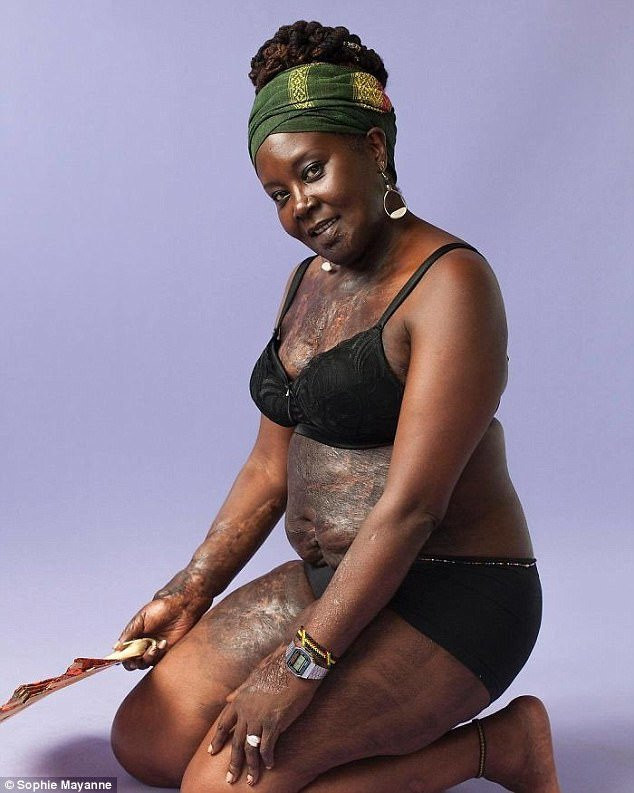 10 co gai dung cam va cau chuyen vet seo di theo ca cuoc doi hinh anh 4