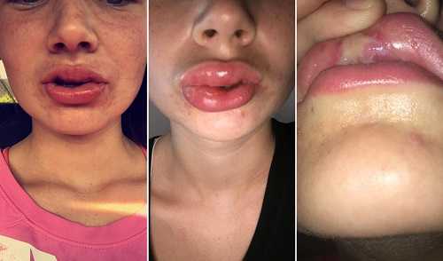 Đôi môi của Abbie sưng to và viêm nhiễm nặng. Ảnh: Facebook.