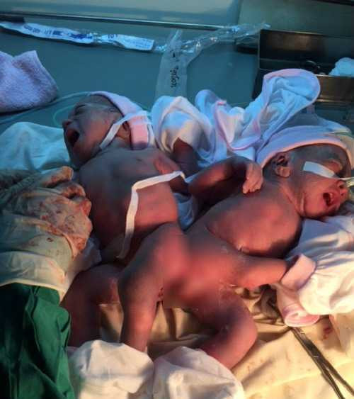 Xót thương hai bé gái song sinh dính liền mông, không có hậu môn - 1