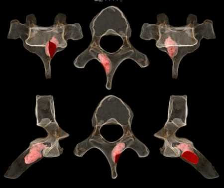 Mẩu xương sống cổ đại 2 triệu tuổi bị ung thư (phần màu hồng). Ảnh: sajs.co.za.