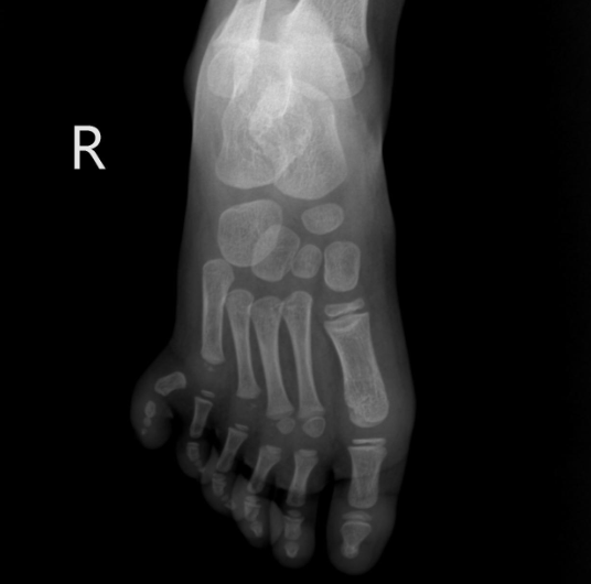 em-be-sinh-ra-co-6-ngon-o-ban-chan-phai