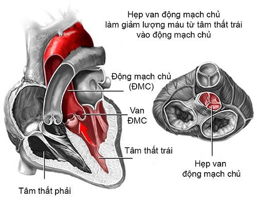 mang-thai-u-xo-tu-cung-benhtim