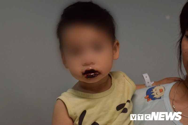 tre-uong-nham-hoa-chat-1 3