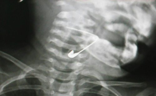 be-18-thang-tuoi-nuot-kim-bang-mac-vao-thanh-quan