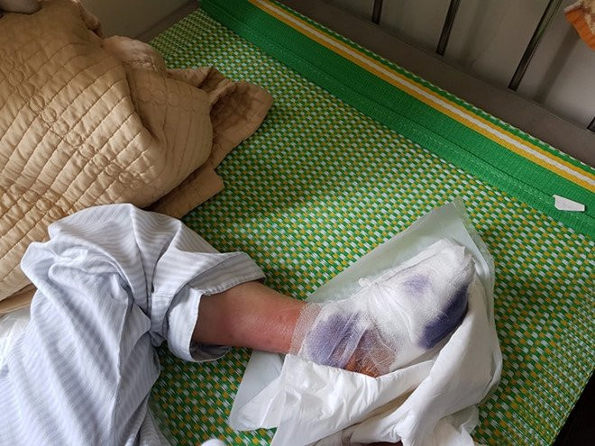 Noi am anh cua benh nhan tieu duong khi phai cat chan hinh anh 2