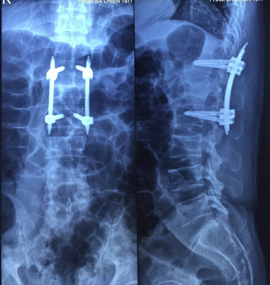 chấn thương cột sống,phẫu thuật,cột sống