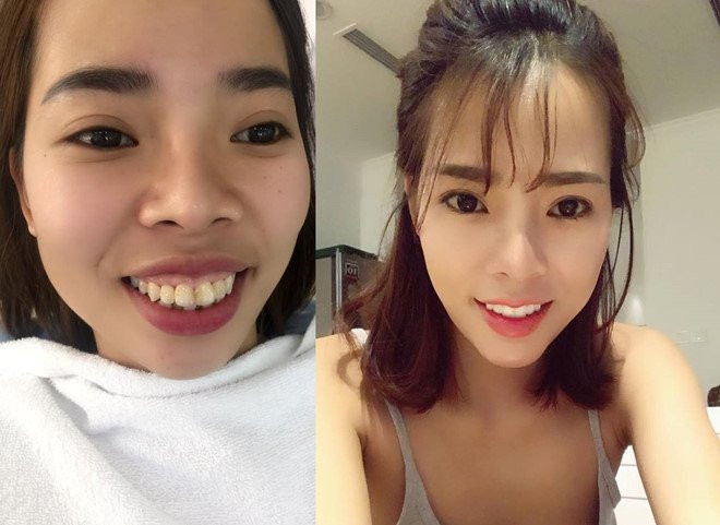 5 co gai Viet lot xac sau khi 'dao keo' hinh anh 1