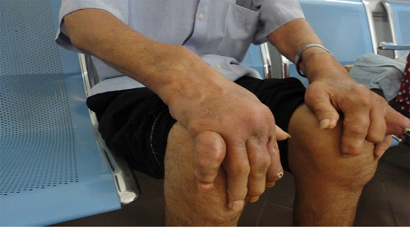 Ham ăn lòng lợn, nam thanh niên bị gút nặng - ảnh 1