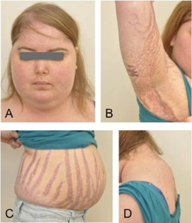 trẻ biếng ăn,biếng ăn,bệnh nhi,còi xương,suy dinh dưỡng,corticoid