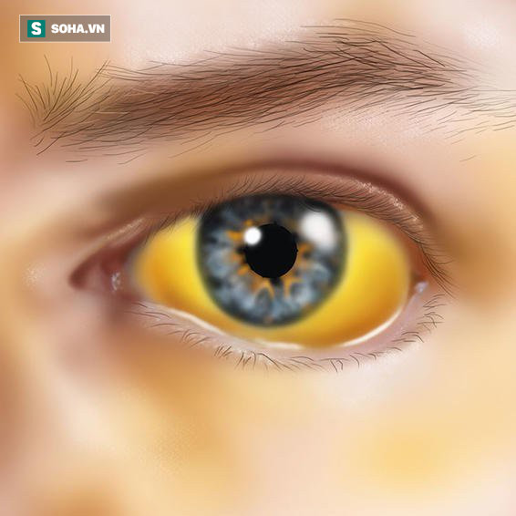 6 dấu hiệu cảnh báo gan đang yếu đi từng ngày: Bạn nên biết trước khi quá muộn - Ảnh 2.