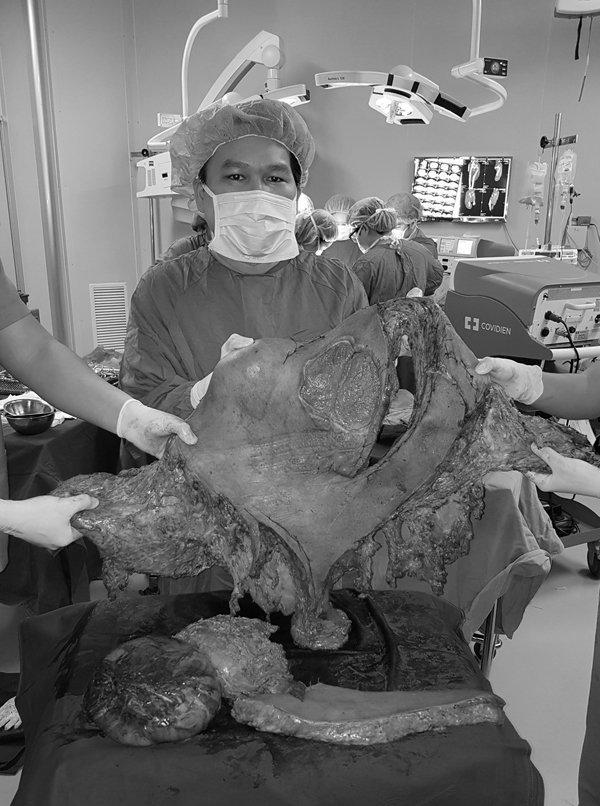 khối u,Bệnh viện Việt Đức,u xơ thần kinh,khối u khổng lồ