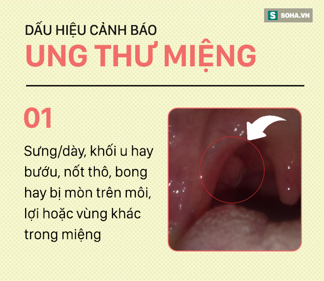 [PHOTO STORY] Đừng nhầm lẫn với bệnh ở miệng, đây là những dấu hiệu cảnh báo ung thư mà bạn nên nhớ - Ảnh 1.