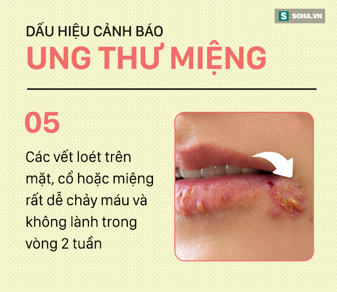 [PHOTO STORY] Đừng nhầm lẫn với bệnh ở miệng, đây là những dấu hiệu cảnh báo ung thư mà bạn nên nhớ - Ảnh 5.