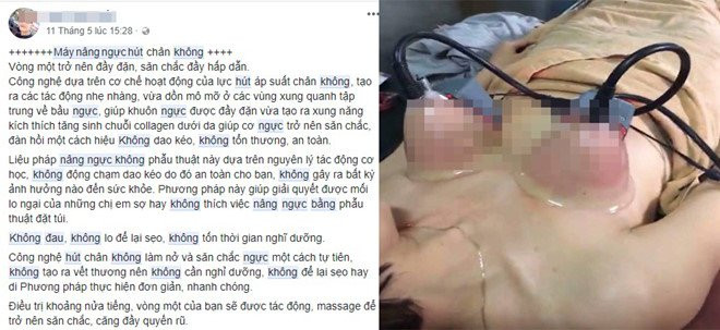 Nang nguc bang may hut chan khong: Tro lua bip cua cac co so lam dep hinh anh 1