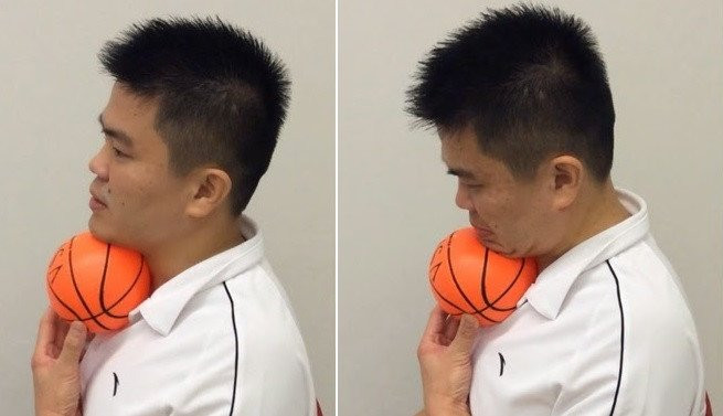 3 cach giam bong mo cam khong can phau thuat hinh anh 4