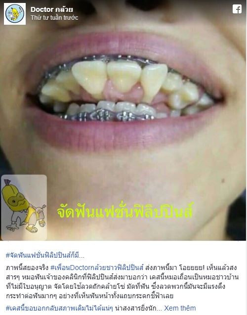 phat-hoang-vi-ham-rang-nieng-sai-cach-dan-den-bien-dang-tram-trong-2 4