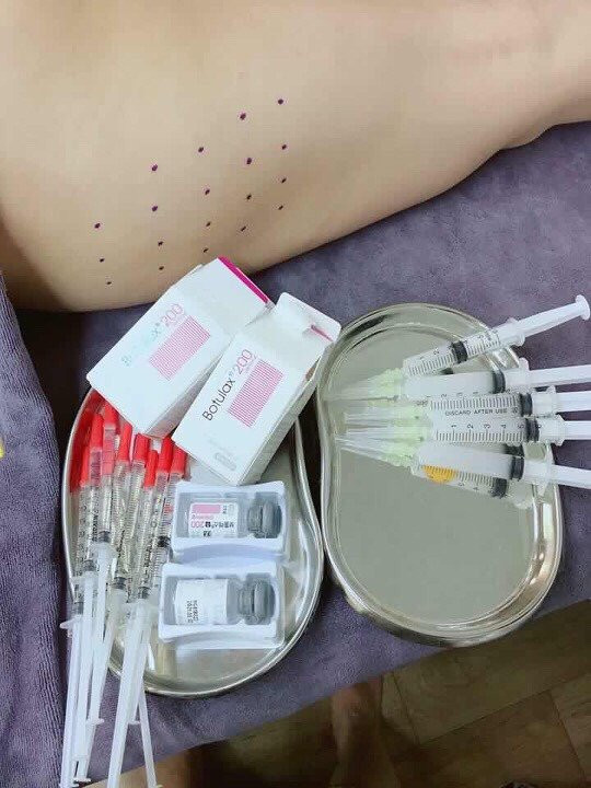 Co gai nhu bup be vo hon sau khi tiem botox lam thon gon mat hinh anh 1