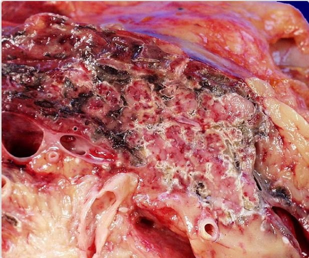 viem tuy cap hoai tu 7