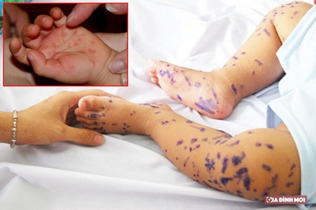 Virus gây bệnh tay chân miệng có thể gây ra nhiều biến chứng nặng như phù phổi, viêm phổi, suy hô hấp và có thể dẫn đến tử vong. Ảnh minh họa