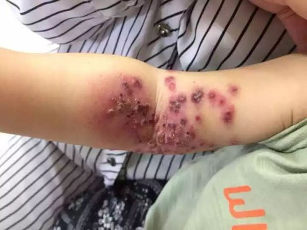 Bé 18 tháng tuổi sưng rộp, lở loét cánh tay vì nụ hôn của mẹ