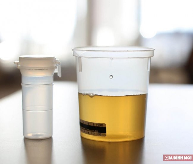 Người đàn ông mắc bệnh lạ, bác sĩ phải lọc... nước tiểu để lấy tinh trùng 0