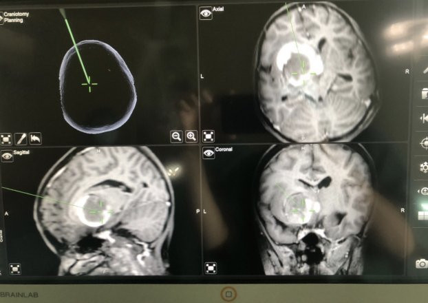 Ca mổ được thực hiện dưới kính hiển vi có hệ thống dẫn đường đảm bảo độ chính xác cao