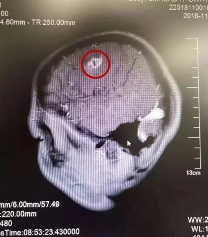 Bác sĩ lôi ký sinh trùng 15cm trong não bé trai, cảnh báo thói quen xấu khi ăn uống