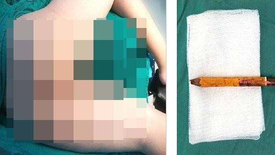 Bé trai bị bút chì đâm xuyên mông vì bạn đùa dại