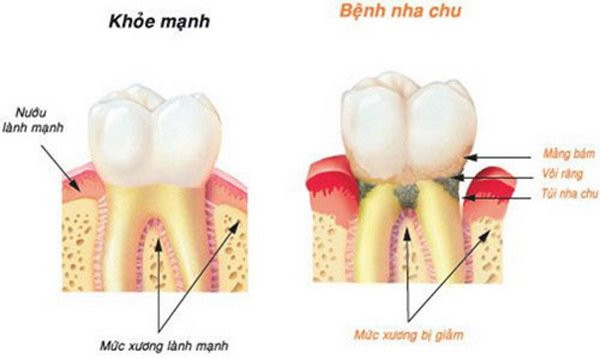 Cô gái 28 tuổi rụng răng, móm mém như cụ bà 80 vì thói quen xấu