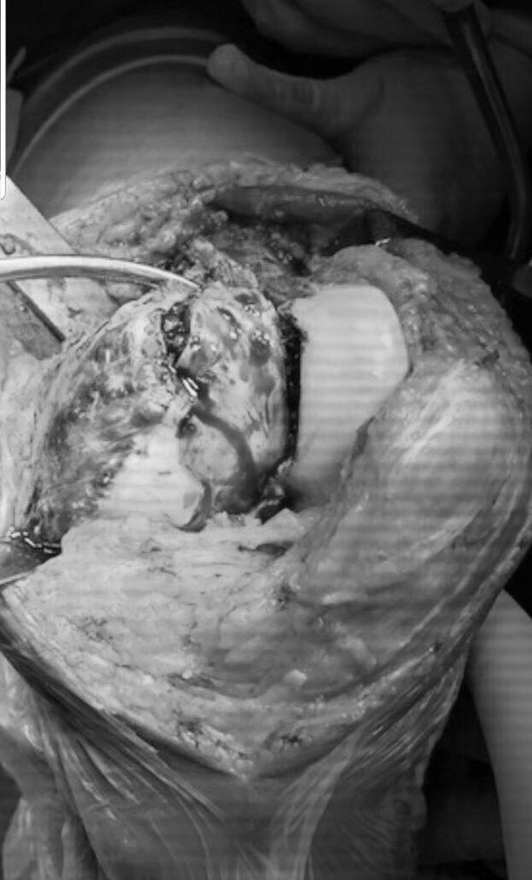 Người phụ nữ 36 tuổi bị khối u ăn mục xương mà không biết