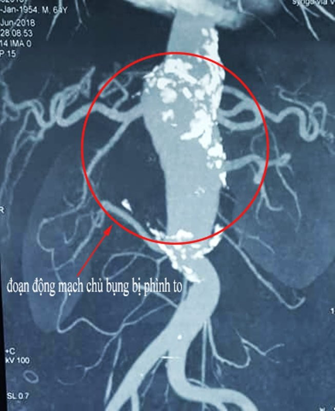 CASE - Phinh dong mach chu bung o vi tri dac biet (2)
