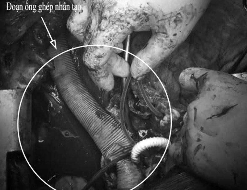 HMCL-ong ghep nhan tao 3