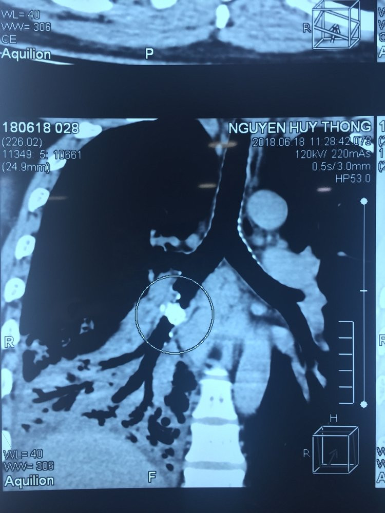 Hinh anh di vat truoc khi phau thuat