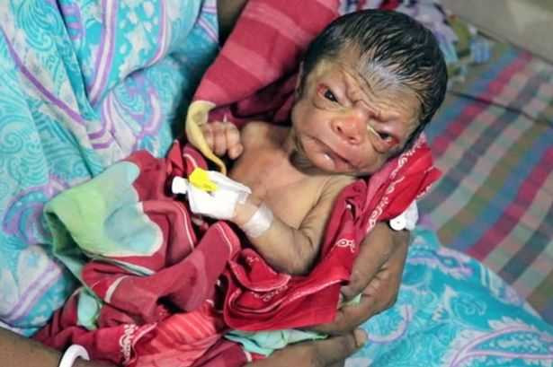 PAY-A-baby-boy-who-was-born-with-a-condition-called-Progeria-in-Bangladesh